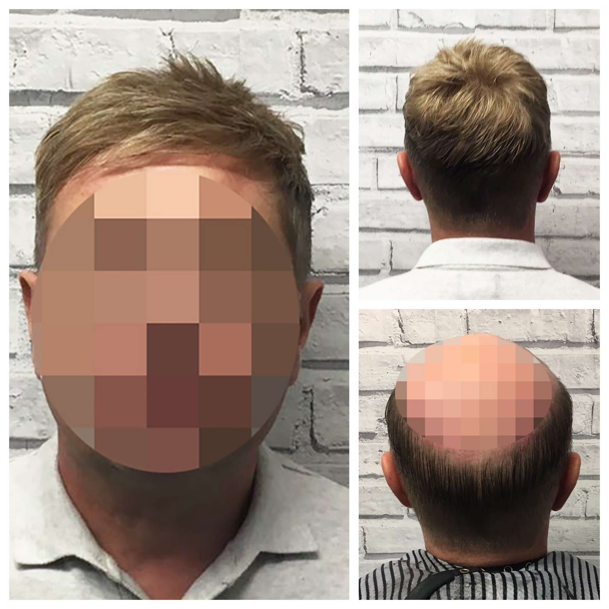 Hair Systems Manchester Specialist non surgical hair loss replacement