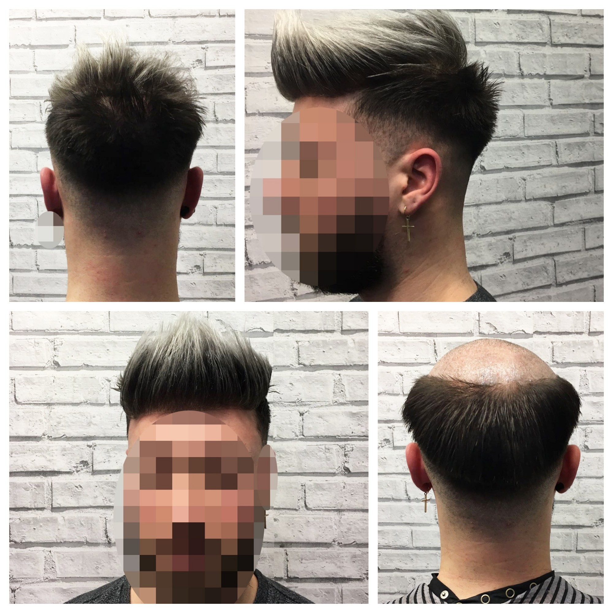 Non surgical hair replacement cost uk