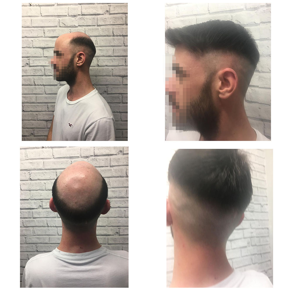 Gallery - Hair Systems Manchester
