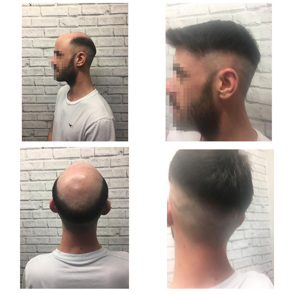 Gallery - Hair Systems Manchester Gallery - Hair Systems Manchester