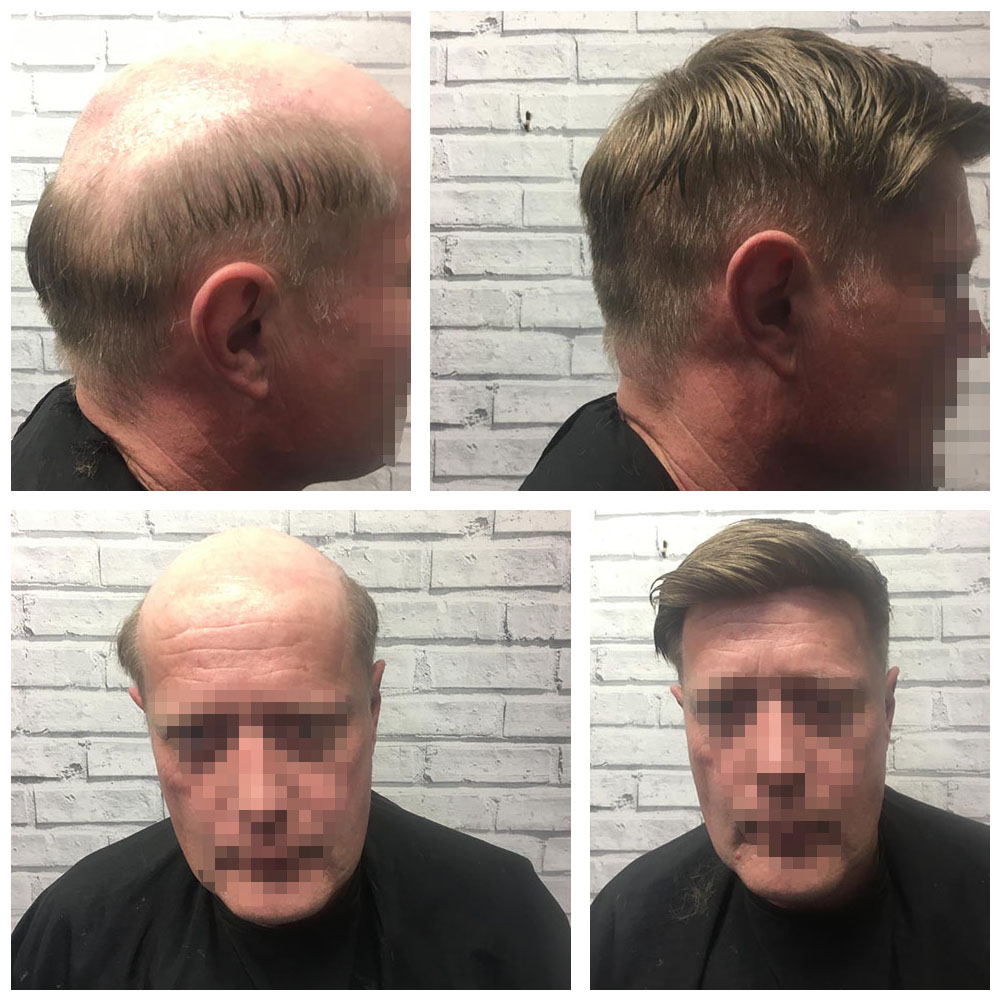 Gallery - Hair Systems Manchester